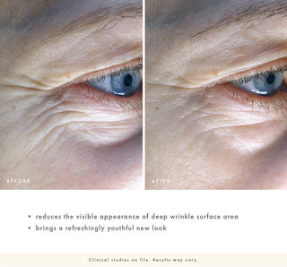 Before and after comparison of eye area with wrinkles, showing a youthful new look.